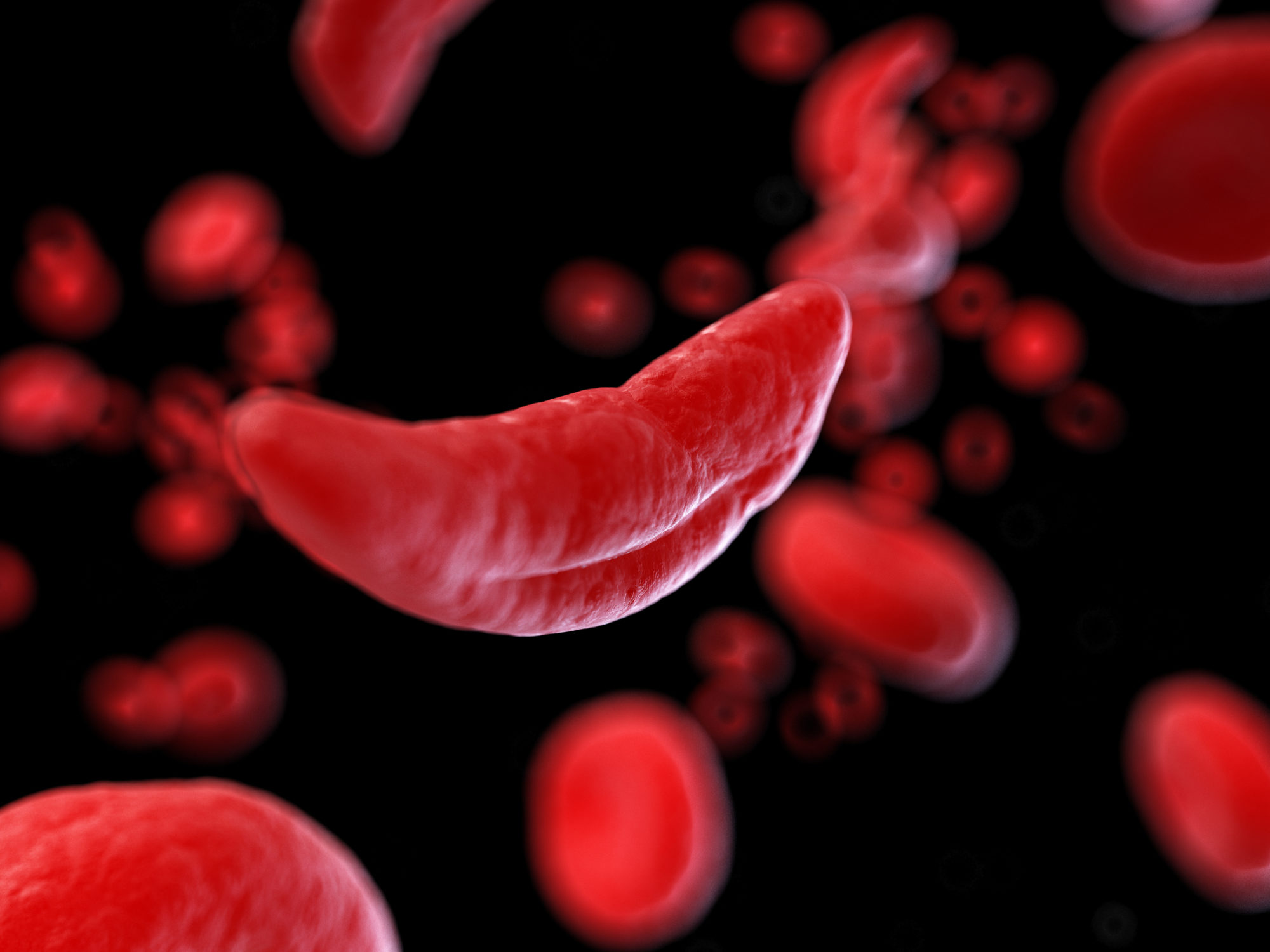 Living well with Sickle Cell Disease