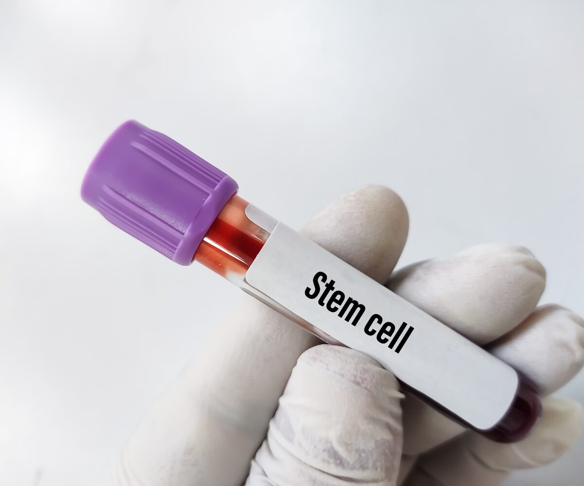 Nuova terapia con cellule staminali per pazienti con tumori ematologici